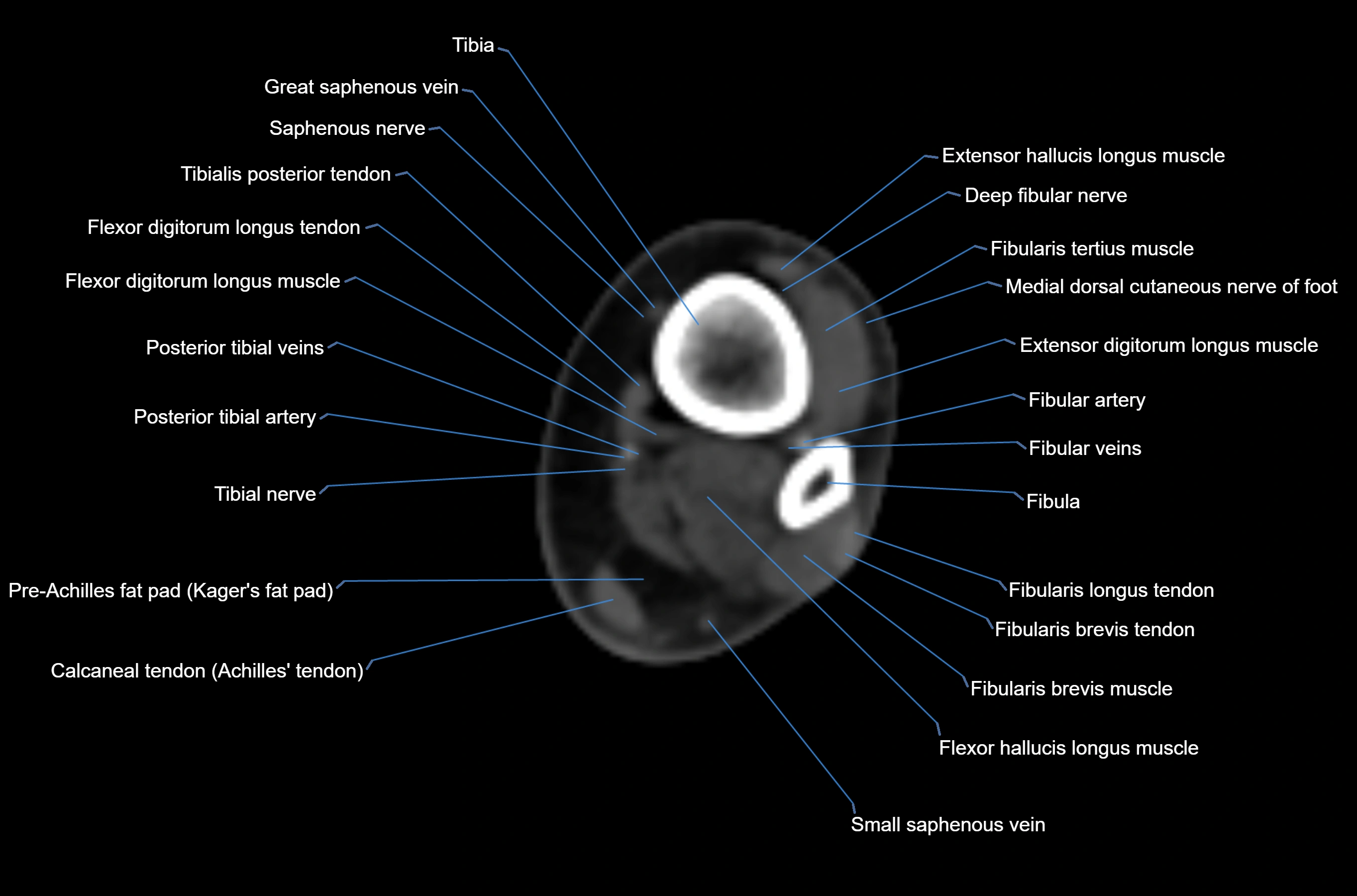 CT Ankle axial cross sectional anatomy labelled image -00015.webp